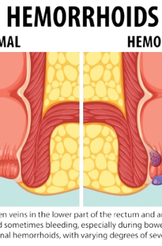 Piles Natural Hemorrhoid Treatment