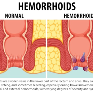 Piles Natural Hemorrhoid Treatment