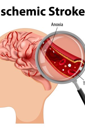 Stroke Prevention Brain care