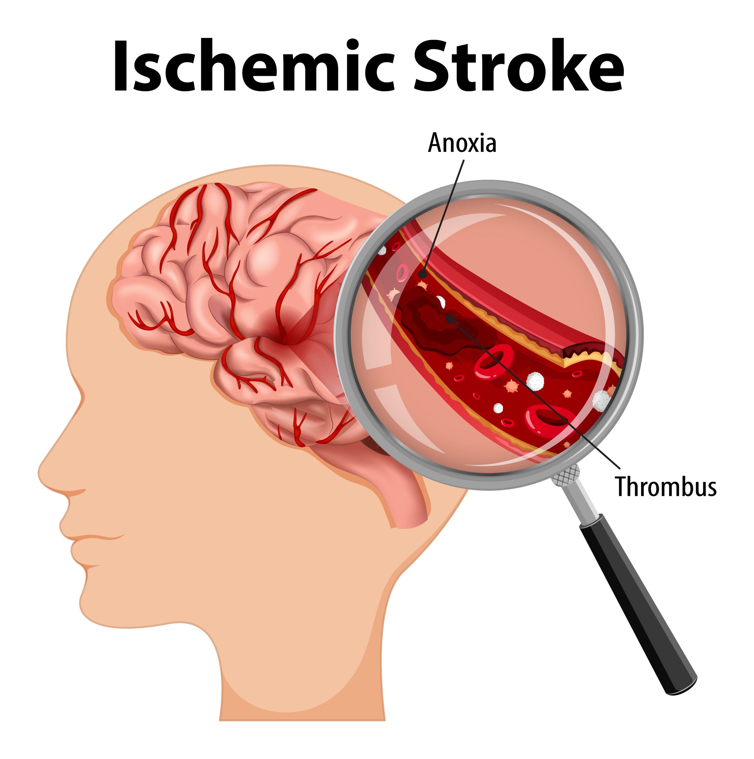 Stroke Prevention Brain care