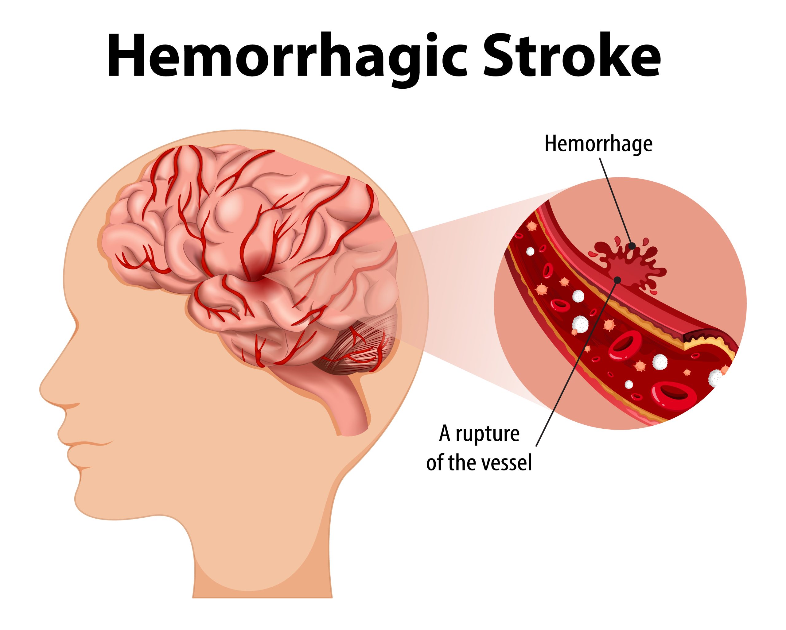 Stroke Prevention Brain care - Image 2