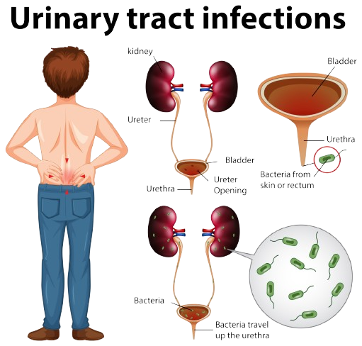 Urinary Infection STD treatment - Image 2